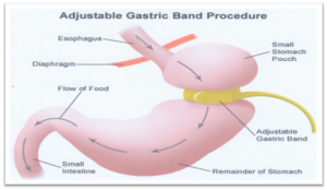 GASTRIC BAND